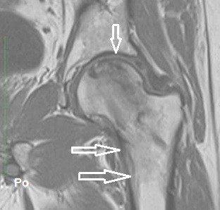 Hip After Treatment